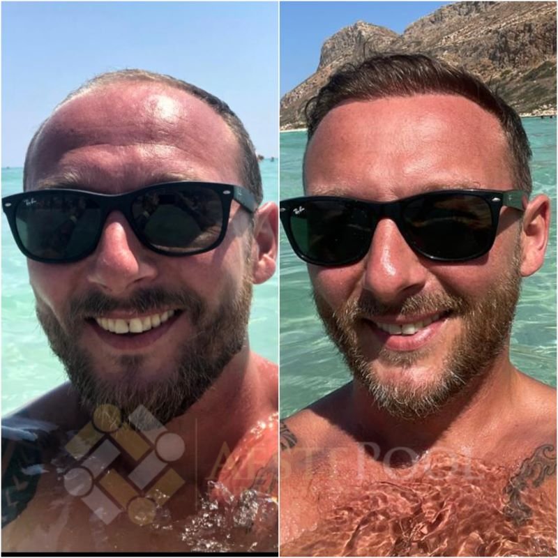 Metamorfoza przeszczepu włosów - Daniel