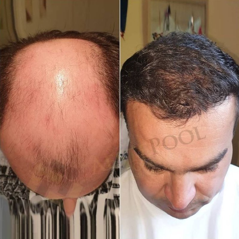 Metamorfoza przeszczepu włosów - Wojtek B.