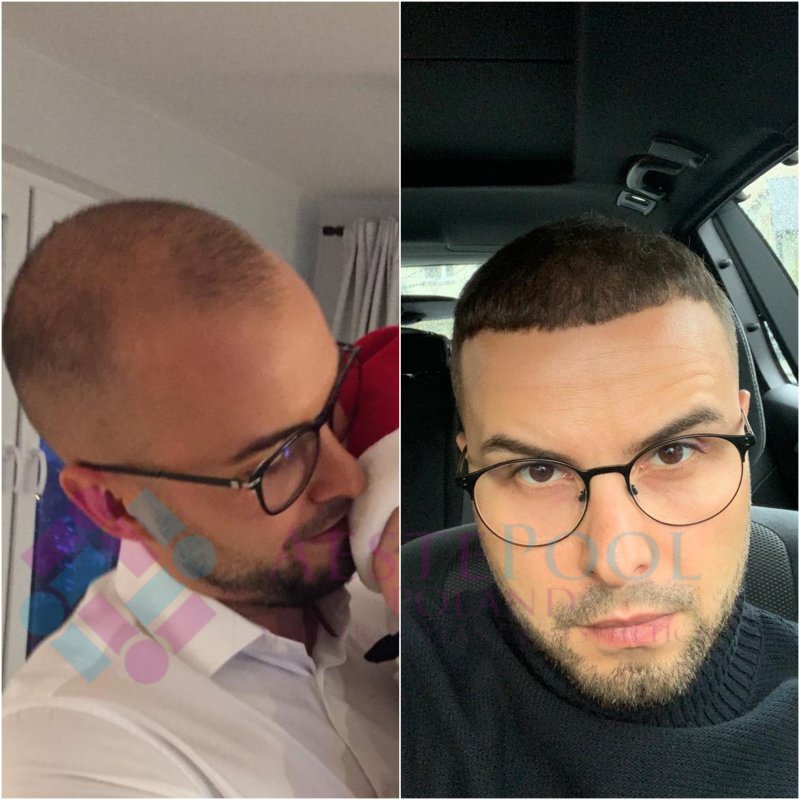 Metamorfoza przeszczepu włosów - Adrian