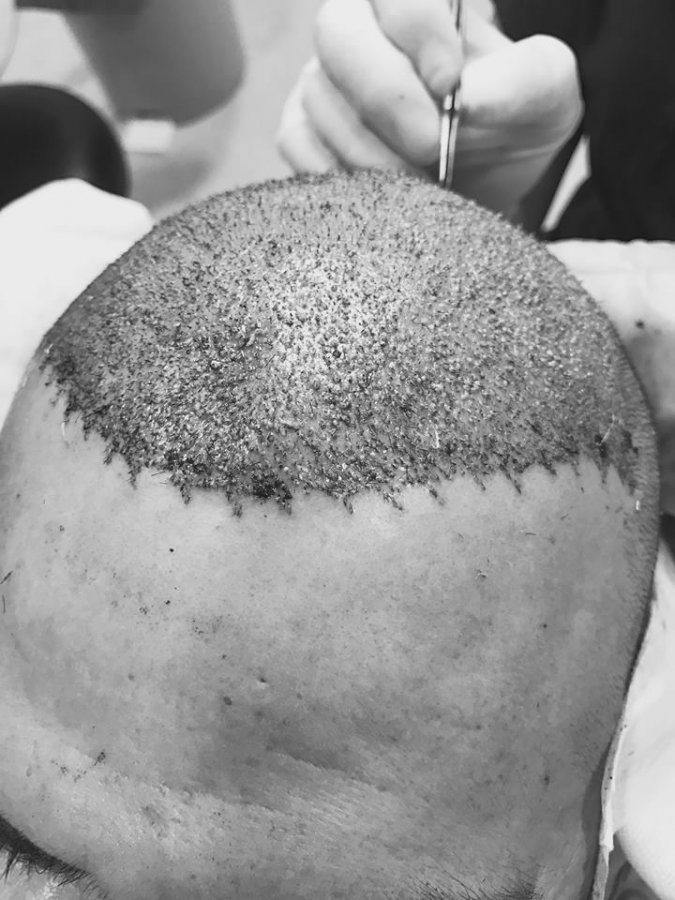 Wypadające włosy - szczotka